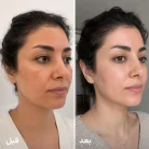 عکس قبل و بعد کرم ضد لک تراست