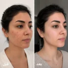قبل و بعد کرم ضد جوش تراست