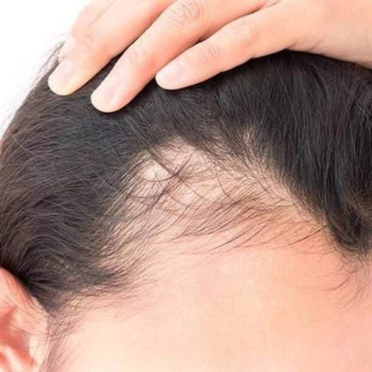 ریزش سکه‌ای مو : علل، علائم، درمان و معرفی سرم بهبوددهنده تراست