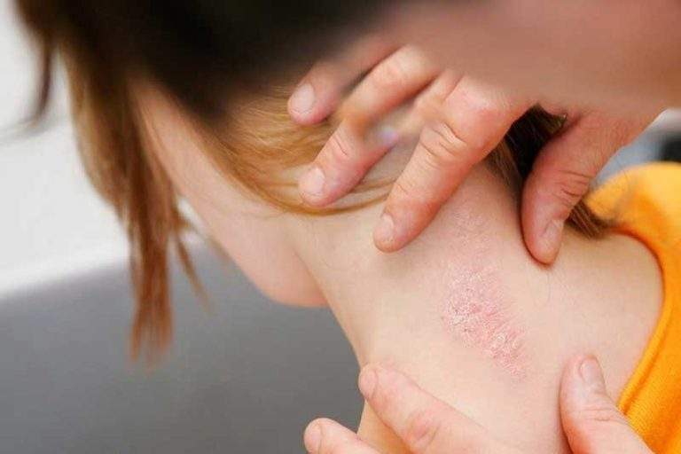 پسوریازیس چیست؟ علت‌ها، علائم و روش‌های کنترل و درمان