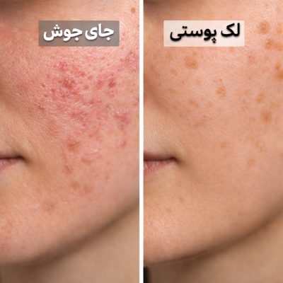 تفاوت لک و جای جوش