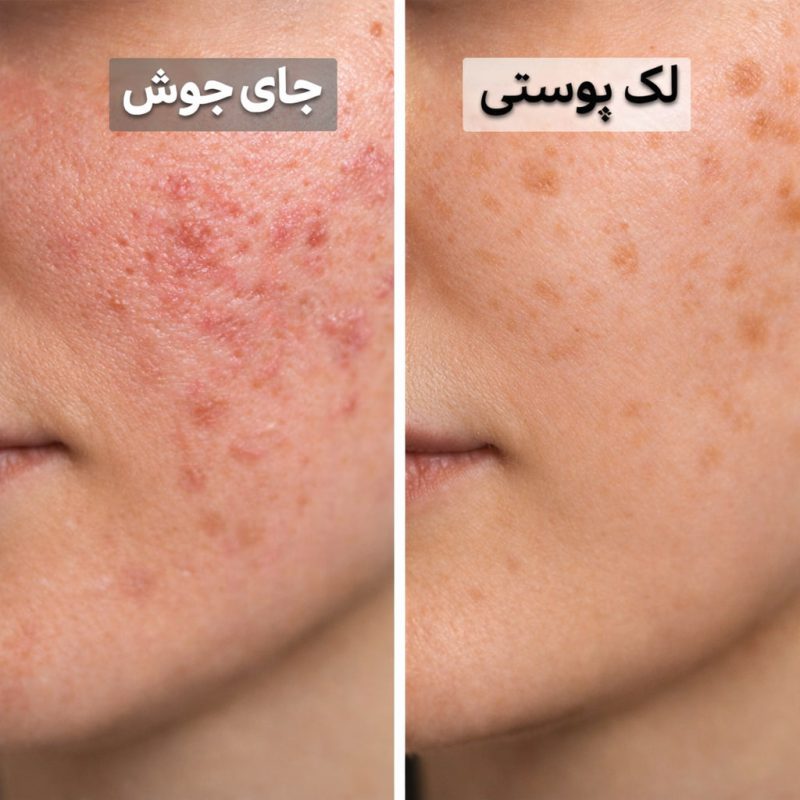 تفاوت لک و جای جوش