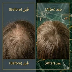 پک ضد ریزش مو تراست