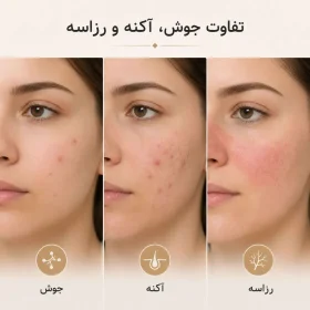تفاوت جوش، آکنه و روزاسه